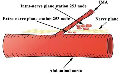 Significance of Nerve Plane for Inferior Mesenteric Plexus Preservation in Laparoscopic Rectal Cancer Surgery